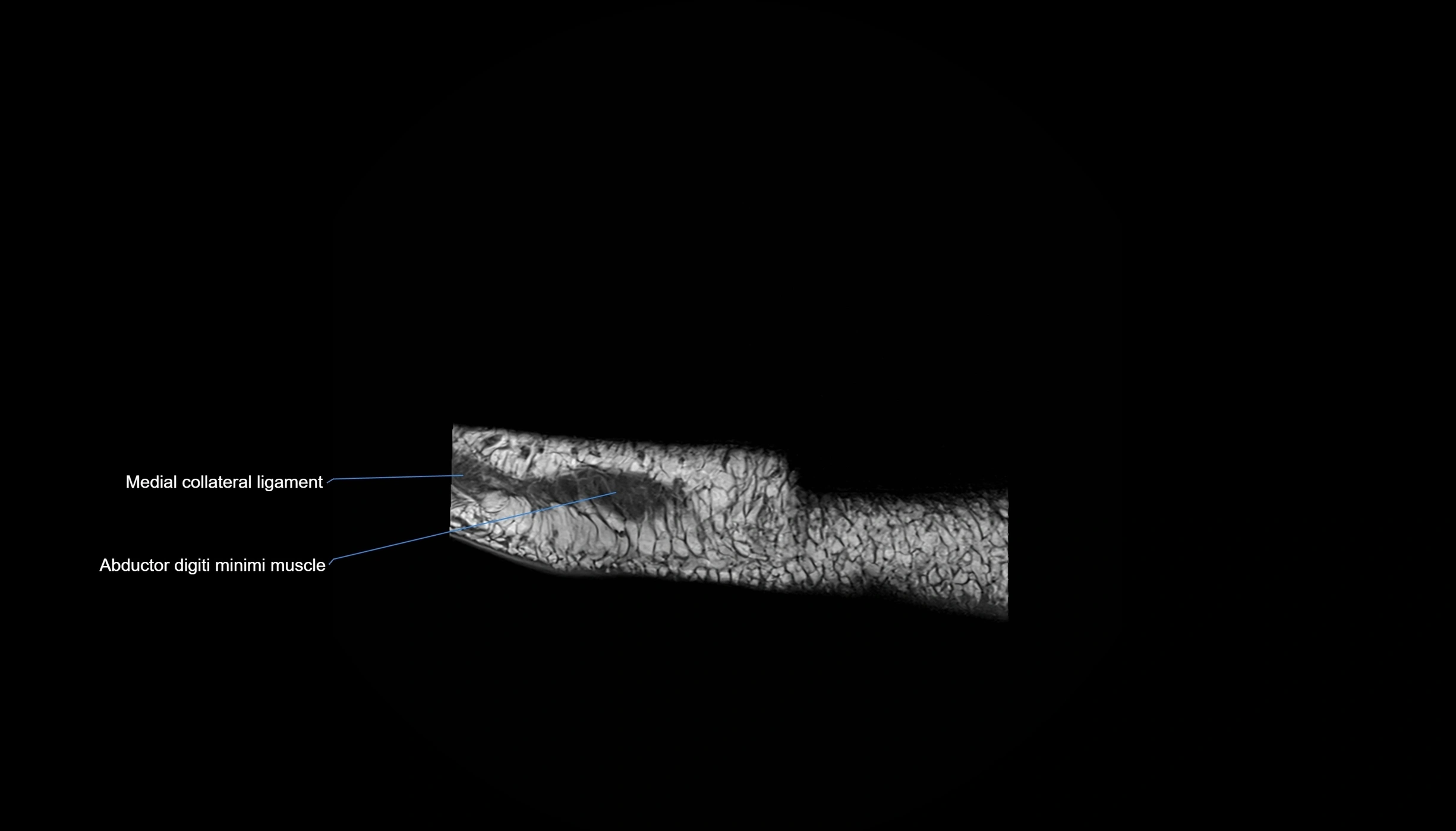 MRI mid foot sagittal cross sectional anatomy 3T  radiology  image-img-00001-00001.webp